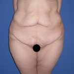 Tummy Tuck Before & After Patient #3246