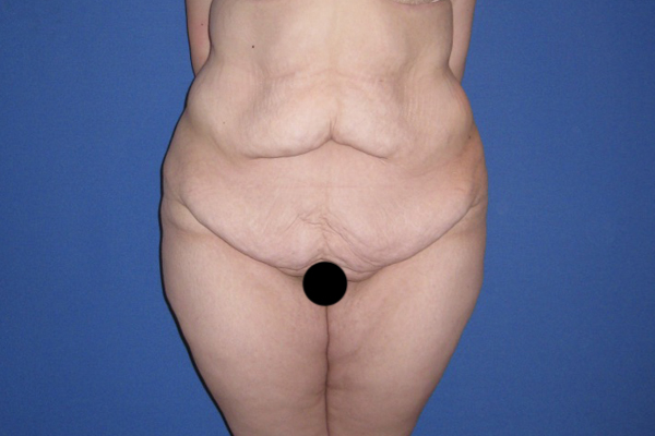 Tummy Tuck Before & After Patient #3246