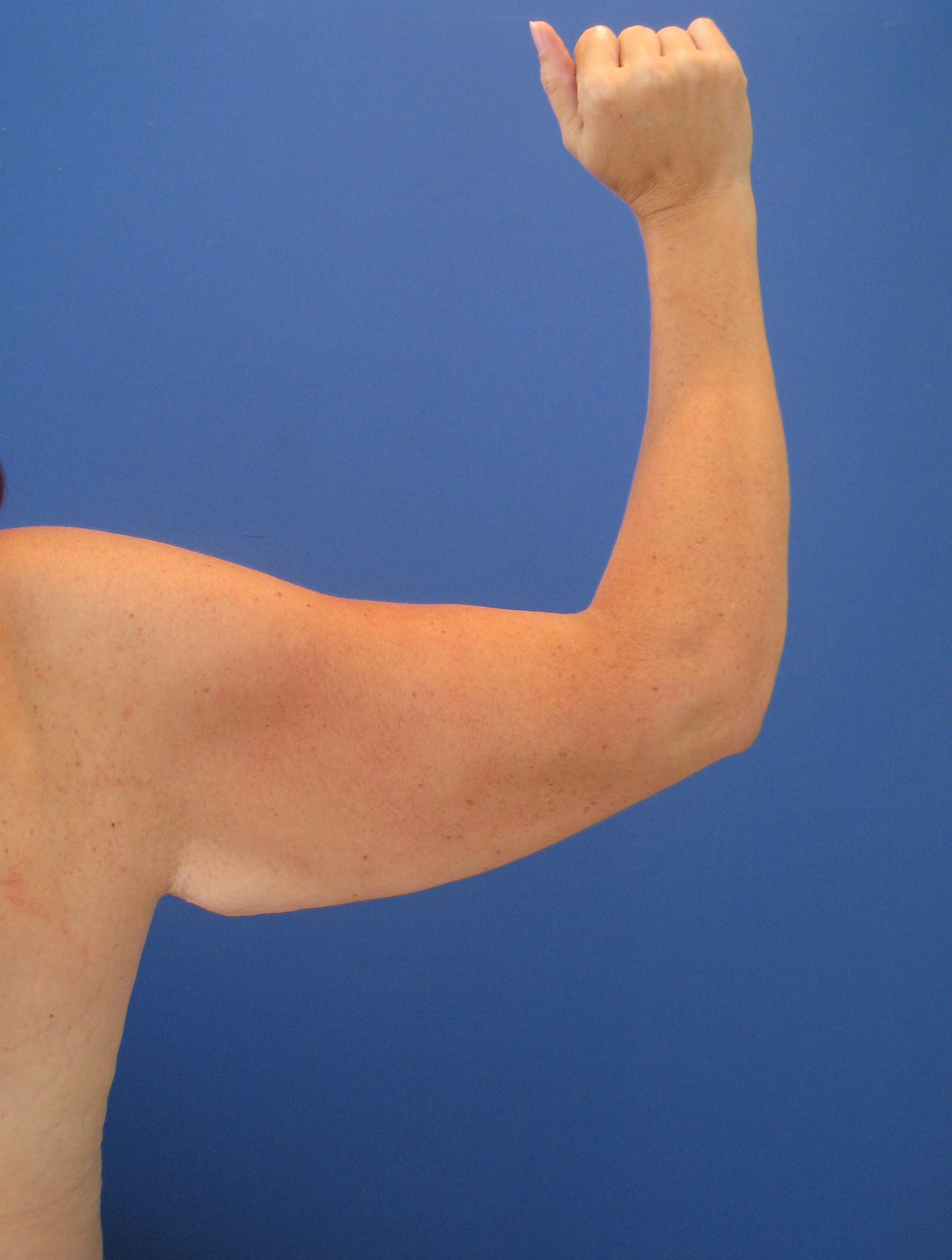 Arm Lift Before & After Patient #3816