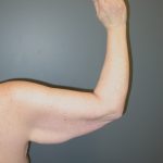 Arm Lift Before & After Patient #3826
