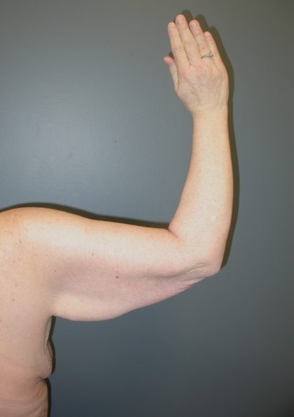 Arm Lift Before & After Patient #3826
