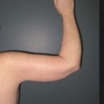 Arm Lift Before & After Patient #3826