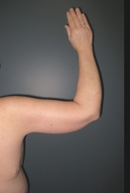 Arm Lift Before & After Patient #3826