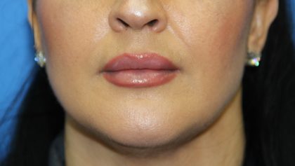 Lip Enhancement Before & After Patient #3790