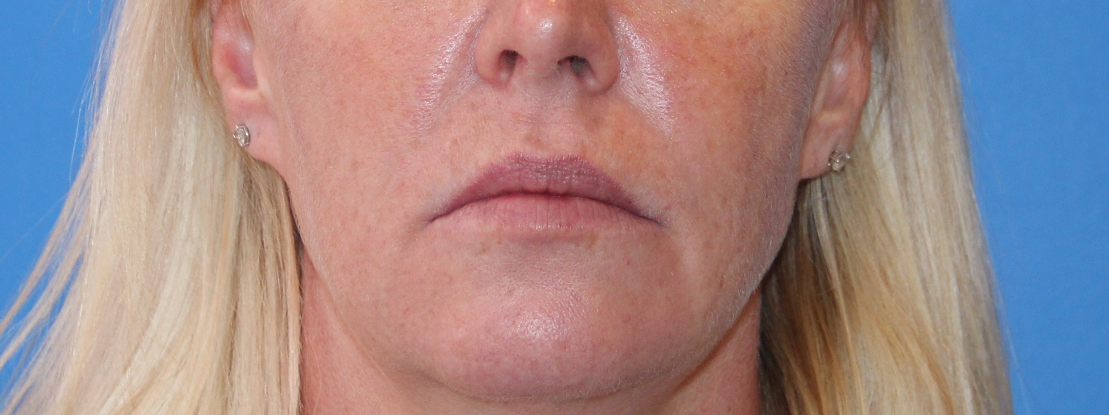 Lip Enhancement Before & After Patient #3793