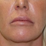 Lip Enhancement Before & After Patient #3793
