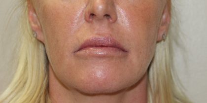 Lip Enhancement Before & After Patient #3793