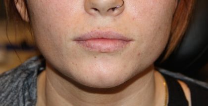 Lip Enhancement Before & After Patient #3796