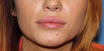 Lip Enhancement Before & After Patient #3796