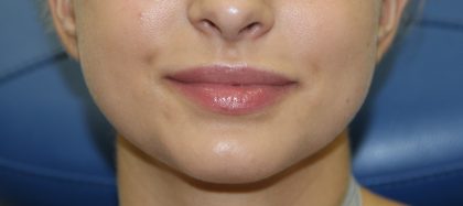 Lip Enhancement Before & After Patient #3799