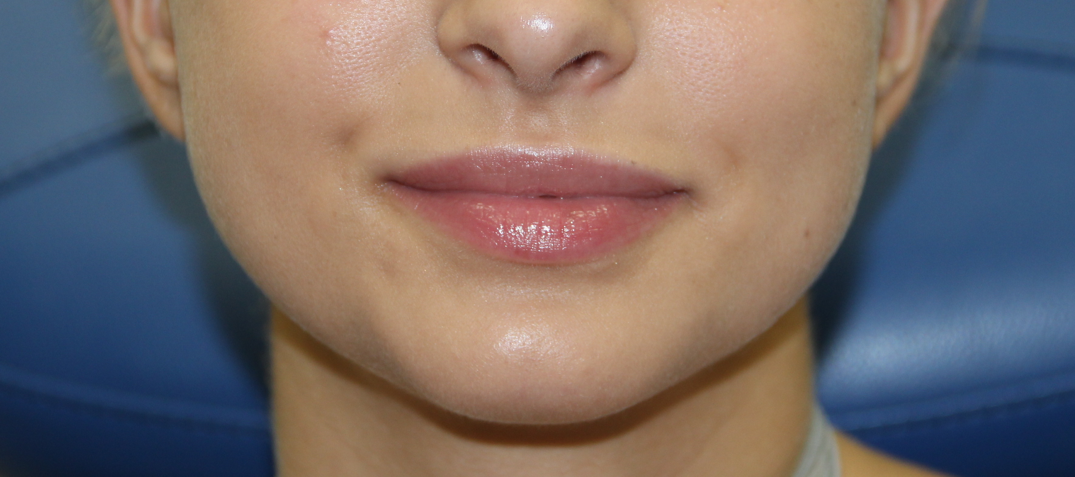 Lip Enhancement Before & After Patient #3799