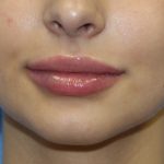 Lip Enhancement Before & After Patient #3799