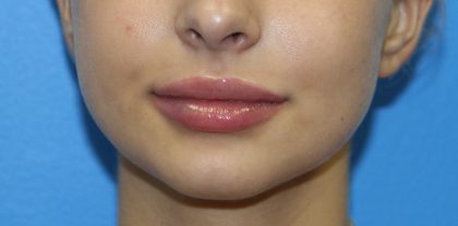 Lip Enhancement Before & After Patient #3799