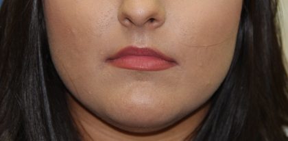 Lip Enhancement Before & After Patient #3802