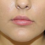 Lip Enhancement Before & After Patient #3802