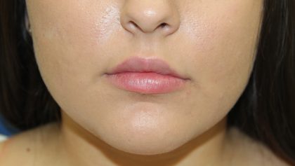 Lip Enhancement Before & After Patient #3802