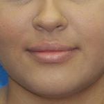 Lip Enhancement Before & After Patient #3805