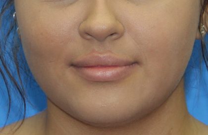 Lip Enhancement Before & After Patient #3805