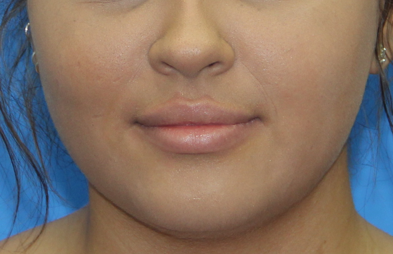 Lip Enhancement Before & After Patient #3805