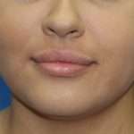 Lip Enhancement Before & After Patient #3805