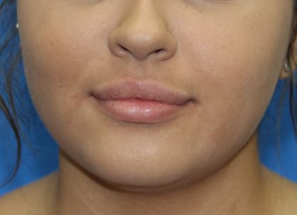 Lip Enhancement Before & After Patient #3805