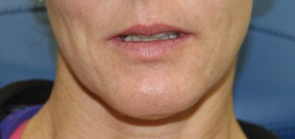 Lip Enhancement Before & After Patient #3808