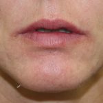 Lip Enhancement Before & After Patient #3808