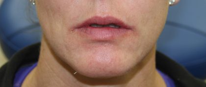 Lip Enhancement Before & After Patient #3808
