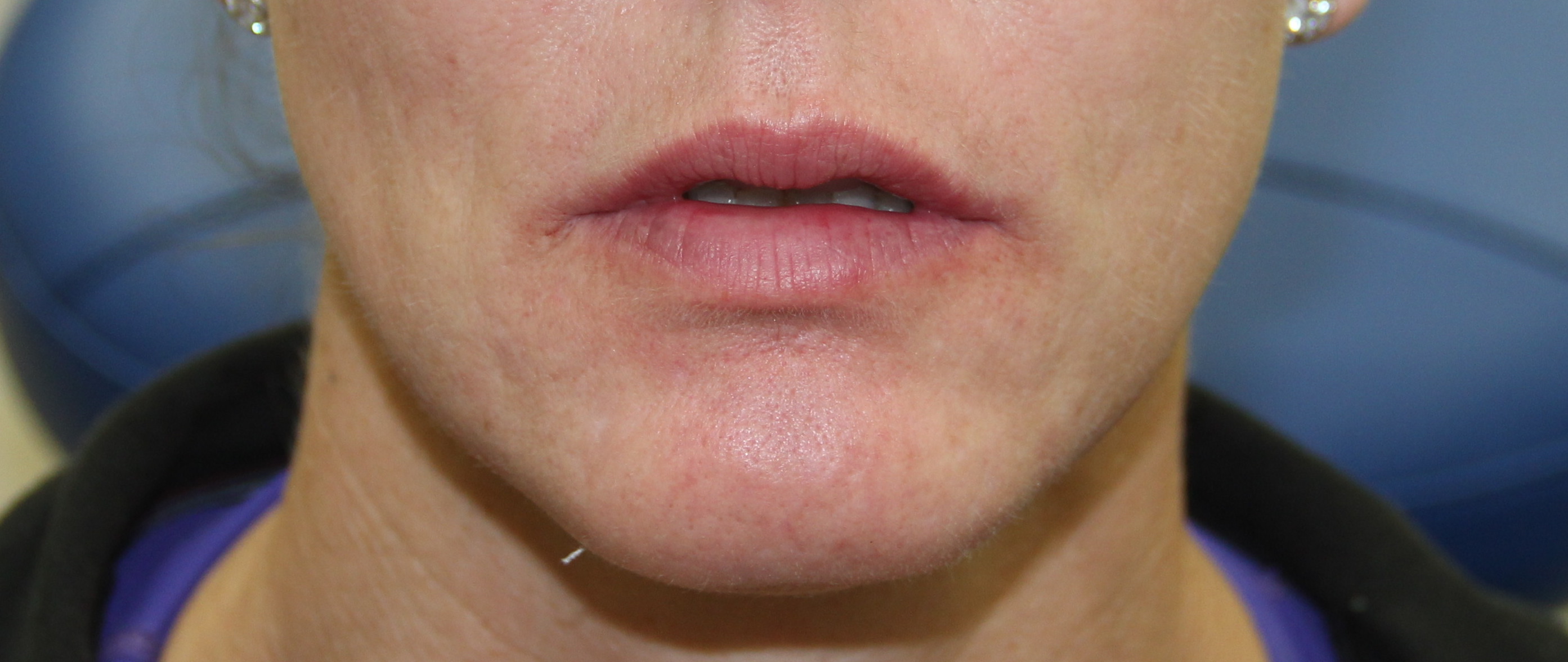 Lip Enhancement Before & After Patient #3808