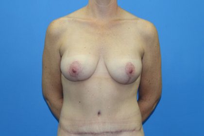 Breast Augmentation with Lift Before & After Patient #3055