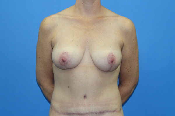 Breast Augmentation with Lift Before & After Patient #3055
