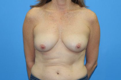 Breast Augmentation with Lift Before & After Patient #2966