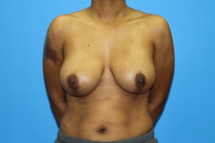 Breast Augmentation with Lift Before & After Patient #3062