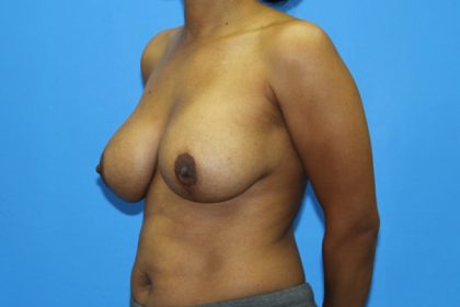 Breast Augmentation with Lift Before & After Patient #3062