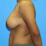 Breast Augmentation with Lift Before & After Patient #3062