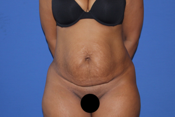 Tummy Tuck Before & After Patient #3260