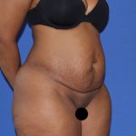 Tummy Tuck Before & After Patient #3260