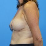 Breast Augmentation with Lift Before & After Patient #2966