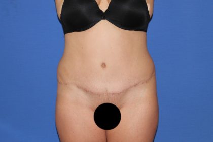 Tummy Tuck Before & After Patient #3331