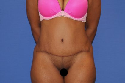 Tummy Tuck Before & After Patient #3260