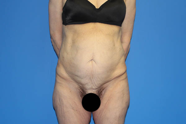 Tummy Tuck Before & After Patient #3408