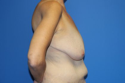 Breast Lift Before & After Patient #3459