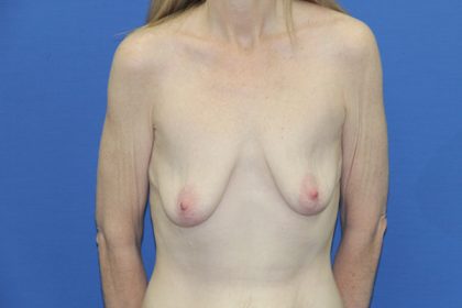 Breast Lift Before & After Patient #3437