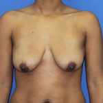 Breast Augmentation with Lift Before & After Patient #3062