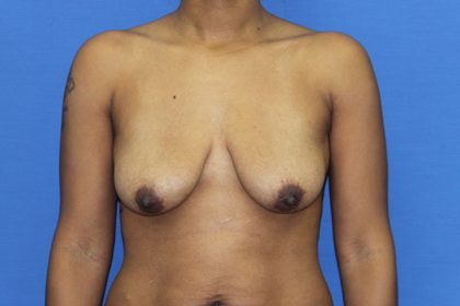 Breast Augmentation with Lift Before & After Patient #3062