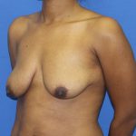 Breast Augmentation with Lift Before & After Patient #3062