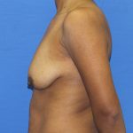 Breast Augmentation with Lift Before & After Patient #3062