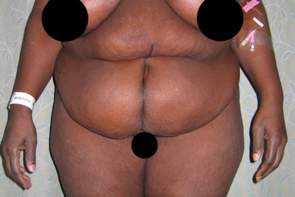 Tummy Tuck Before & After Patient #3387