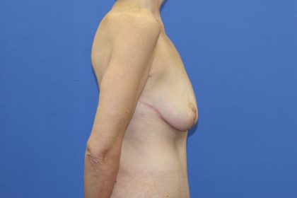 Breast Lift Before & After Patient #3459