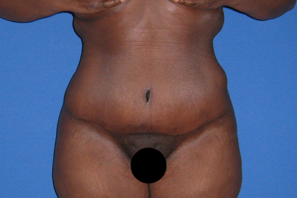 Tummy Tuck Before & After Patient #3387